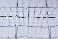 Over hartritmevariabiliteit